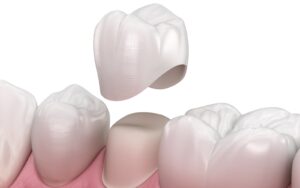 dental crown