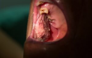 Oral Cancer