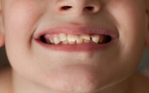 Damaged Teeth