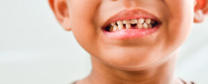 A close-up of a young boy's smile, highlighting broken and severely decayed upper front teeth as a result of early childhood caries.