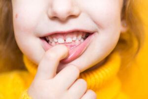 A close-up of a young child smiling and showing their teeth, using a finger to point toward their upper gums.
