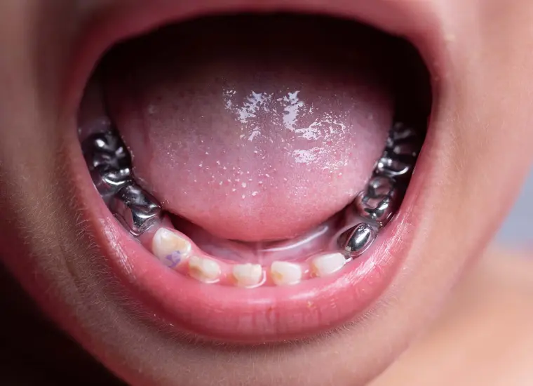 Pediatric Dental Crowns Richmond TX