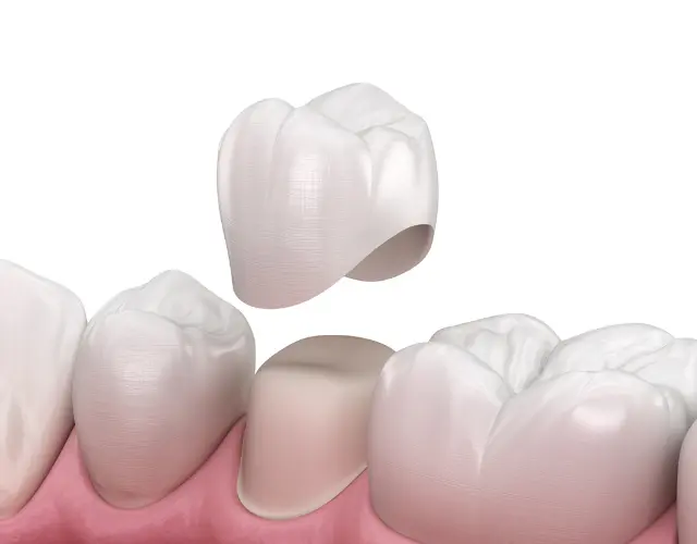 Why Should I Choose Dental Crowns