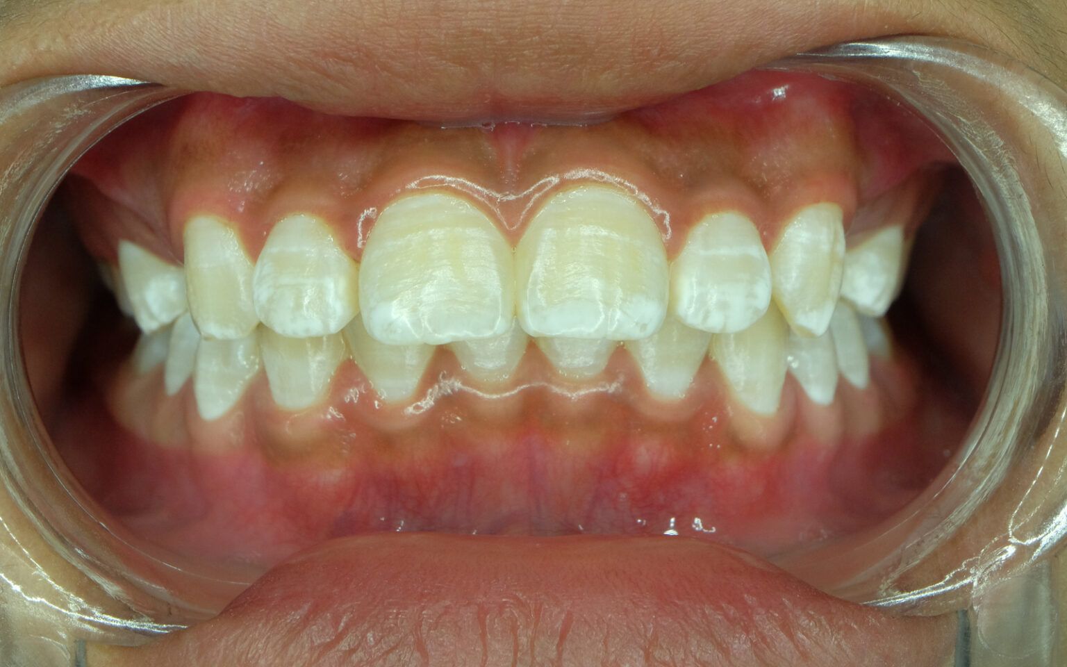 how-white-spot-lesions-happen-with-braces-kids-360-pediatric-dentistry