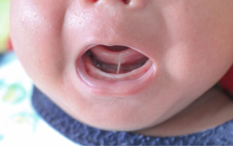 Infant with tongue tie
